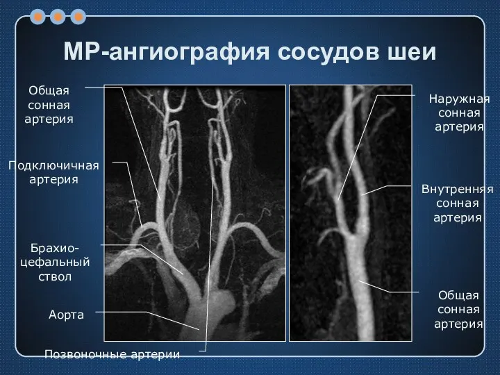 МР-ангиография сосудов шеи Аорта Брахио-цефальный ствол Общая сонная артерия Подключичная