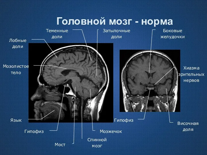 Головной мозг - норма Язык Спинной мозг Мозжечок Мост Гипофиз