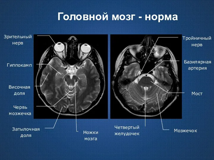 Головной мозг - норма Затылочная доля Червь мозжечка Ножки мозга