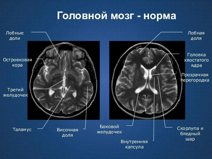 Головной мозг - норма Лобные доли Третий желудочек Островковая кора