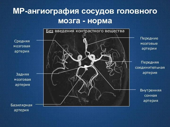 МР-ангиография сосудов головного мозга - норма Без введения контрастного вещества