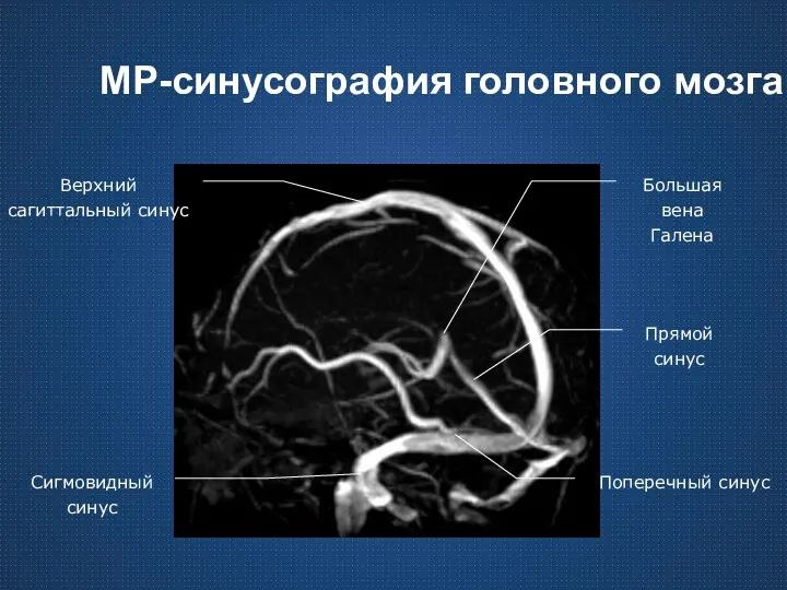 МР-синусография головного мозга Верхний сагиттальный синус Сигмовидный синус Поперечный синус Большая вена Галена Прямой синус