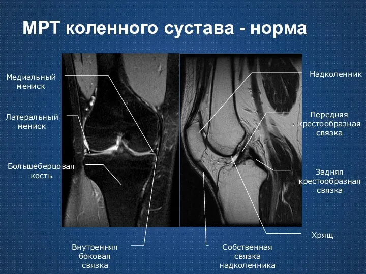 МРТ коленного сустава - норма Большеберцовая кость Задняя крестообразная связка