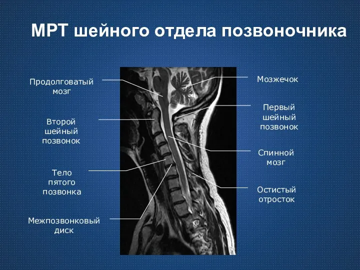 МРТ шейного отдела позвоночника Продолговатый мозг Спинной мозг Второй шейный