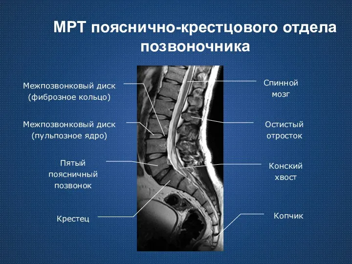 МРТ пояснично-крестцового отдела позвоночника Крестец Пятый поясничный позвонок Межпозвонковый диск