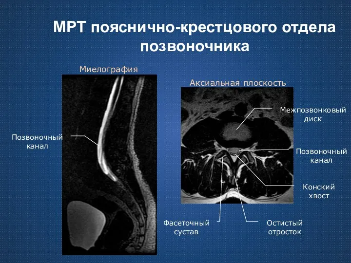 МРТ пояснично-крестцового отдела позвоночника Миелография Аксиальная плоскость Позвоночный канал Остистый