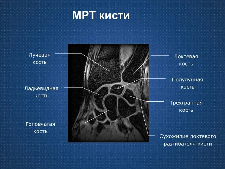 МРТ кисти Лучевая кость Локтевая кость Ладьевидная кость Полулунная кость