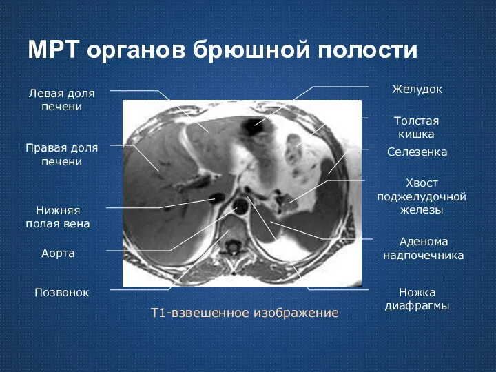 МРТ органов брюшной полости Т1-взвешенное изображение Правая доля печени Левая