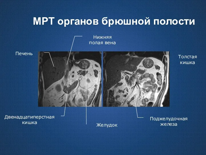 МРТ органов брюшной полости Двенадцатиперстная кишка Печень Нижняя полая вена Желудок Поджелудочная железа Толстая кишка