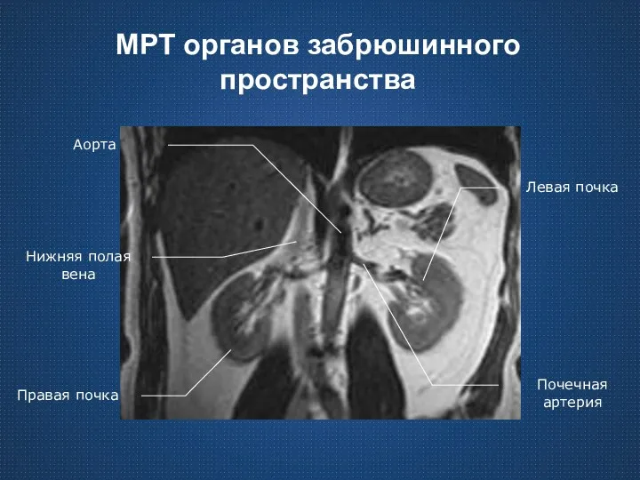 МРТ органов забрюшинного пространства Правая почка Левая почка Аорта Почечная артерия Нижняя полая вена