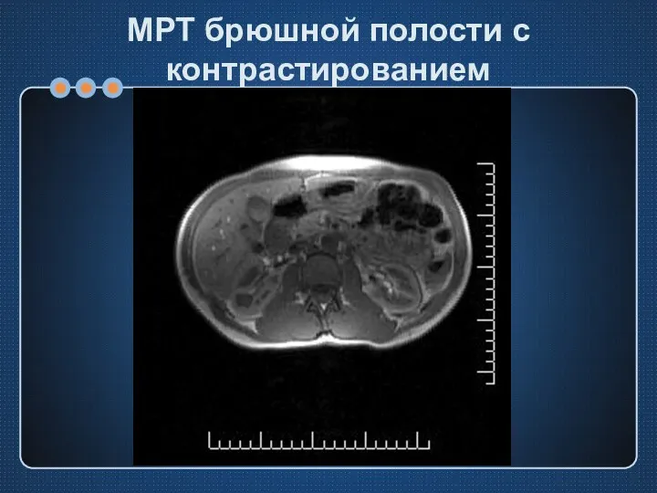 МРТ брюшной полости с контрастированием