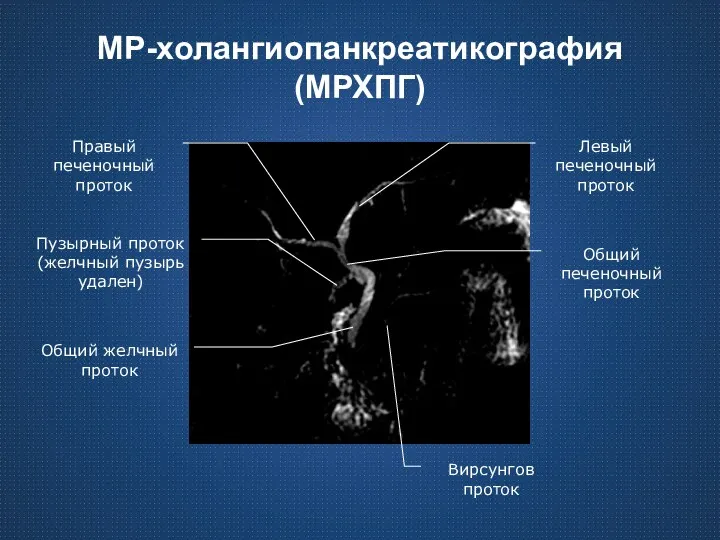 МР-холангиопанкреатикография (МРХПГ) Общий желчный проток Вирсунгов проток Пузырный проток (желчный