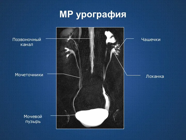 МР урография Мочевой пузырь Мочеточники Лоханка Чашечки Позвоночный канал