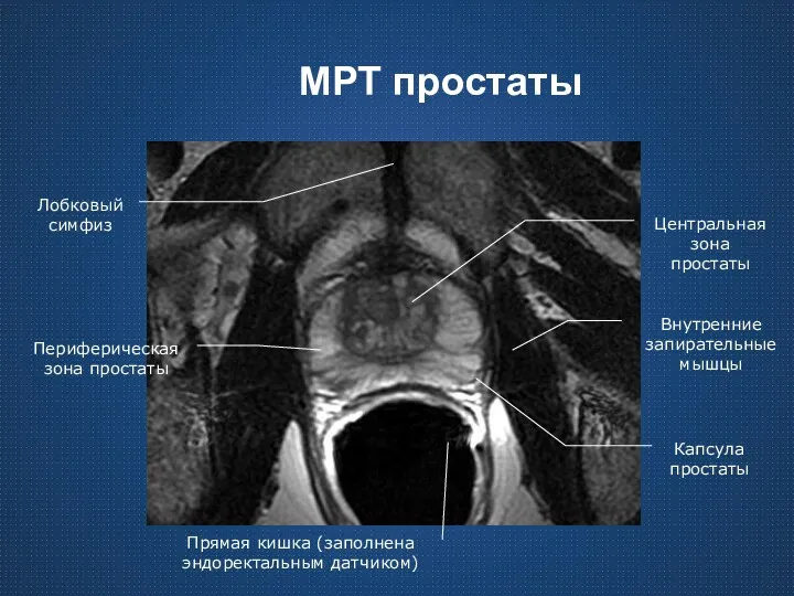 МРТ простаты Лобковый симфиз Периферическая зона простаты Прямая кишка (заполнена