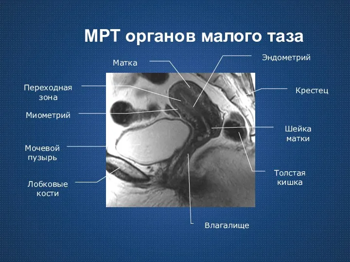 МРТ органов малого таза Мочевой пузырь Матка Лобковые кости Толстая