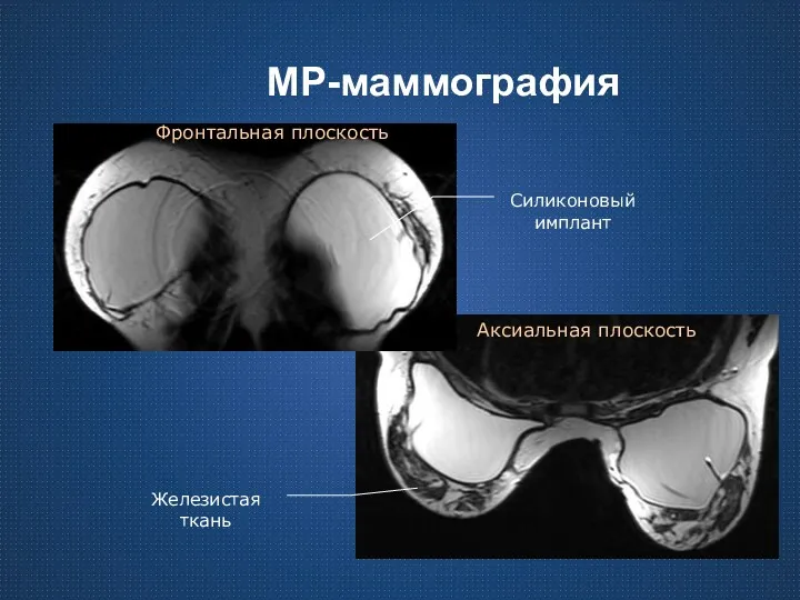 МР-маммография Силиконовый имплант Железистая ткань Фронтальная плоскость Аксиальная плоскость