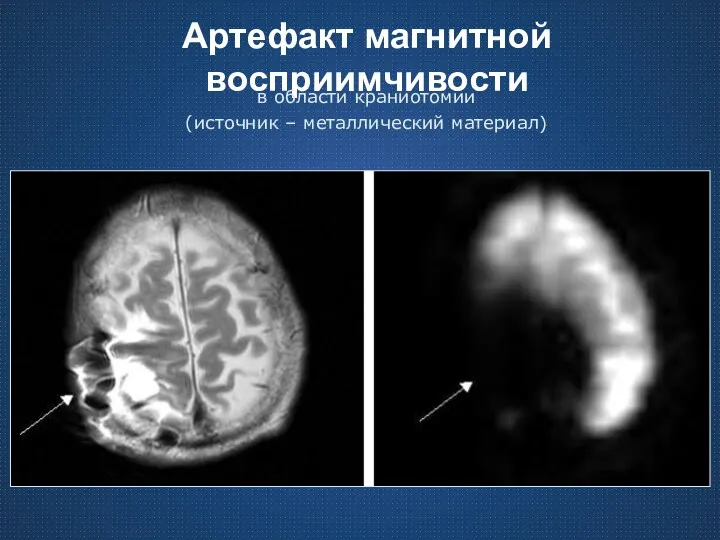 Артефакт магнитной восприимчивости в области краниотомии (источник – металлический материал)