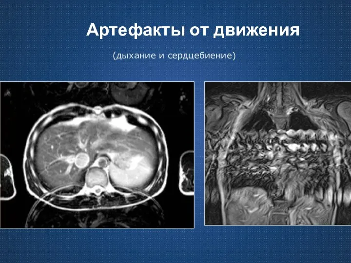 Артефакты от движения (дыхание и сердцебиение)