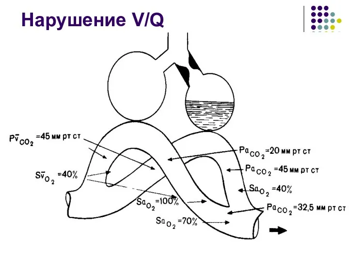 Нарушение V/Q