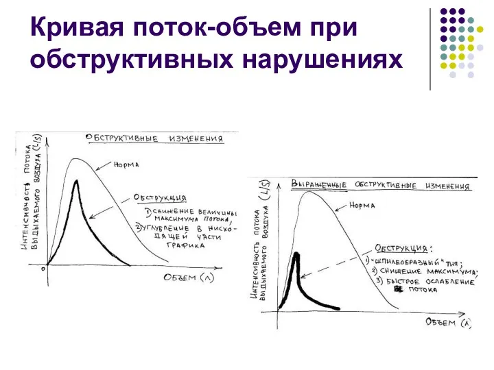 Кривая поток-объем при обструктивных нарушениях