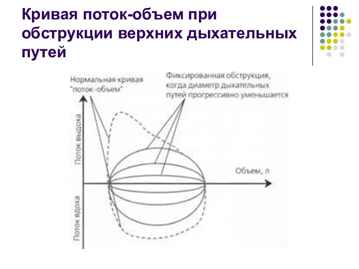 Кривая поток-объем при обструкции верхних дыхательных путей