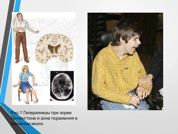 Рис.1 Гиперкинезы при хорее Гентингтона и зона поражения в головном мозге.