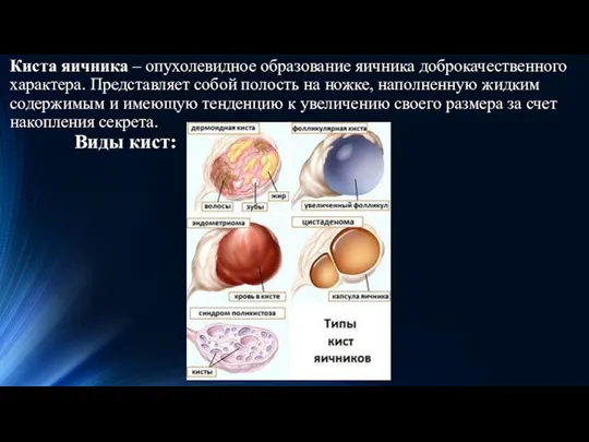 Киста яичника – опухолевидное образование яичника доброкачественного характера. Представляет собой полость на ножке,