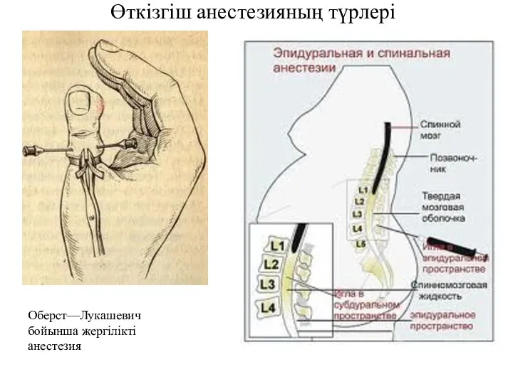 Оберст—Лукашевич бойынша жергілікті анестезия Өткізгіш анестезияның түрлері