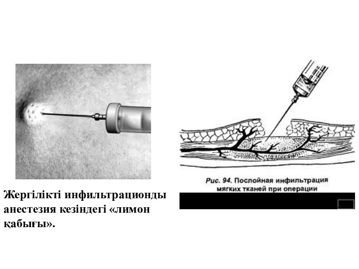 Жергілікті инфильтрационды анестезия кезіндегі «лимон қабығы».