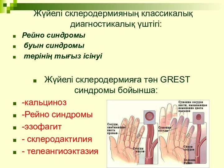 Жүйелі склеродермияның классикалық диагностикалық үштігі: Рейно синдромы буын синдромы терінің