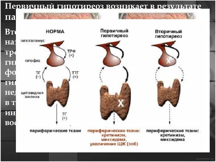 Первичный гипотиреоз возникает в результате патологий щитовидной железы. Вторичную форму
