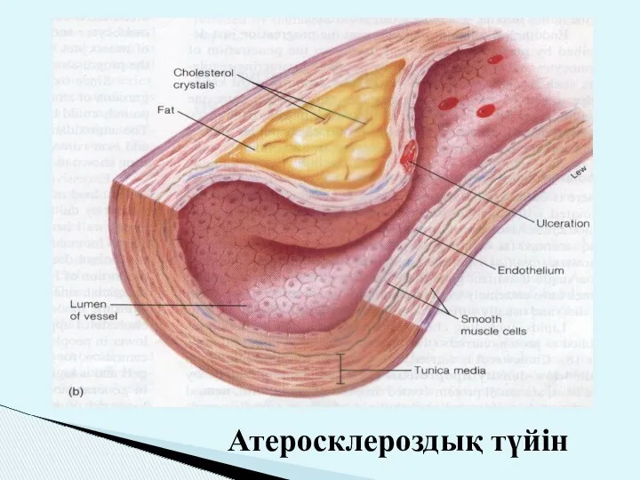 Атеросклероздық түйін