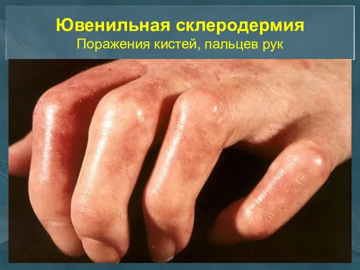 Ювенильная склеродермия Поражения кистей, пальцев рук