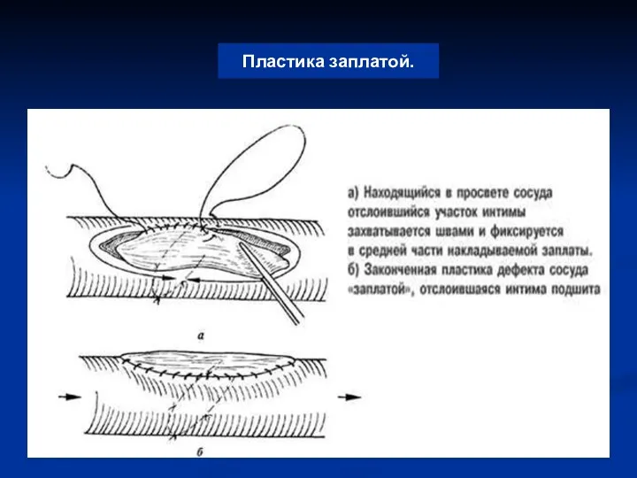 Пластика заплатой.