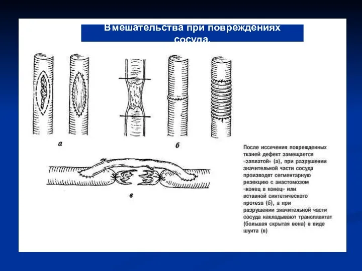 Вмешательства при повреждениях сосуда.