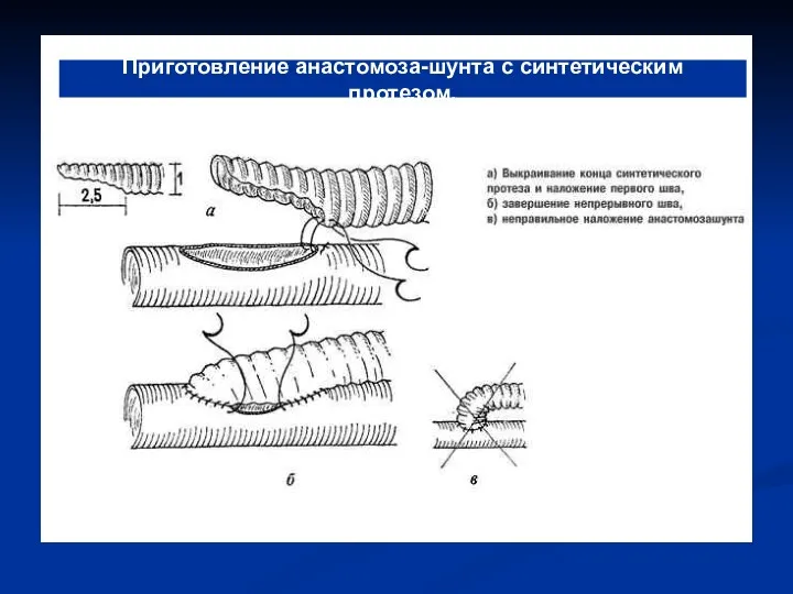 Приготовление анастомоза-шунта с синтетическим протезом.