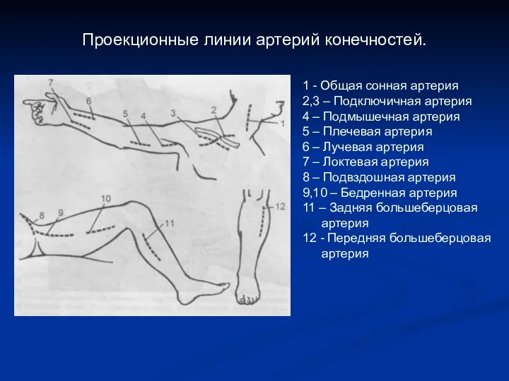 Проекционные линии артерий конечностей. 1 - Общая сонная артерия 2,3 – Подключичная артерия