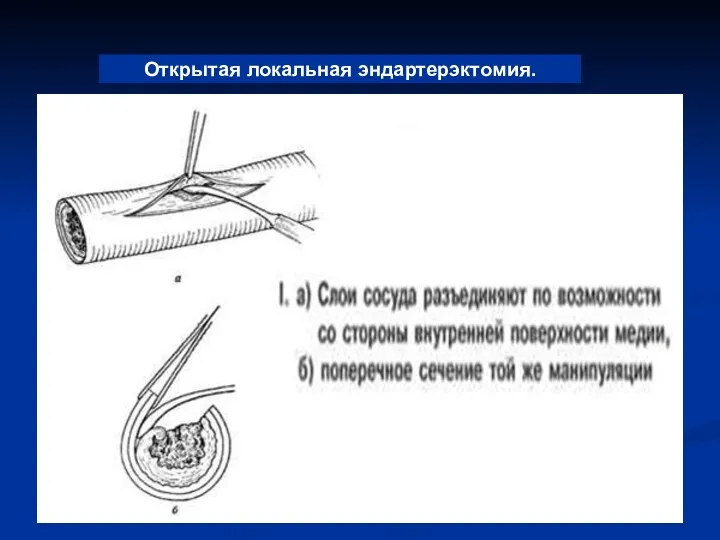 Открытая локальная эндартерэктомия.