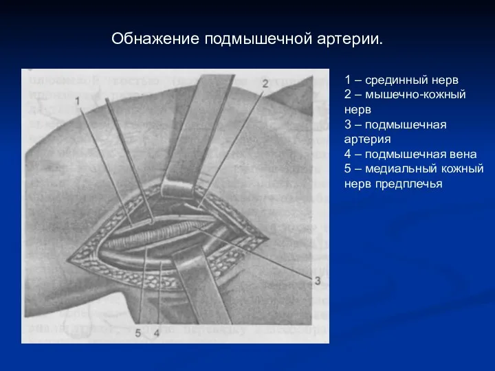 Обнажение подмышечной артерии. 1 – срединный нерв 2 – мышечно-кожный нерв 3 –