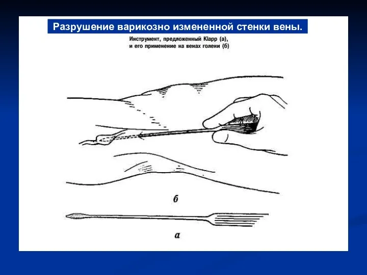 Разрушение варикозно измененной стенки вены.