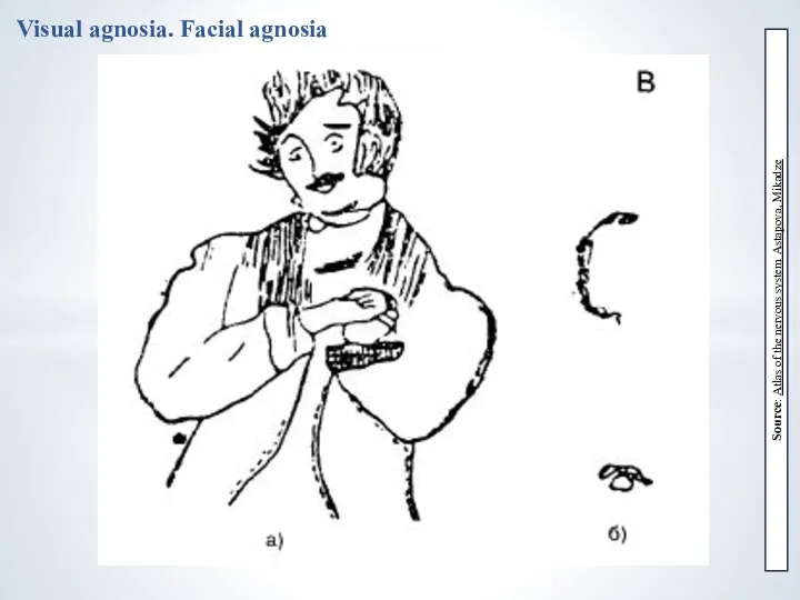Visual agnosia. Facial agnosia Source: Atlas of the nervous system Astapova, Mikadze