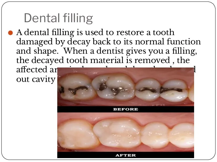 Dental filling A dental filling is used to restore a tooth damaged by