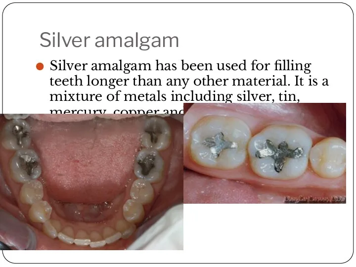 Silver amalgam Silver amalgam has been used for filling teeth longer than any