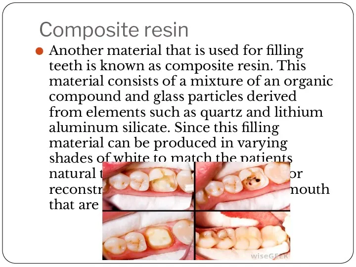 Composite resin Another material that is used for filling teeth