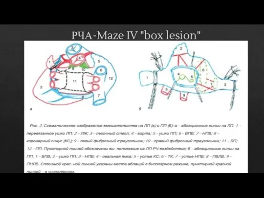 РЧА-Maze IV "box lesion"