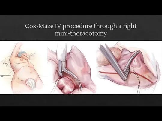 Cox-Maze IV procedure through a right mini-thoracotomy