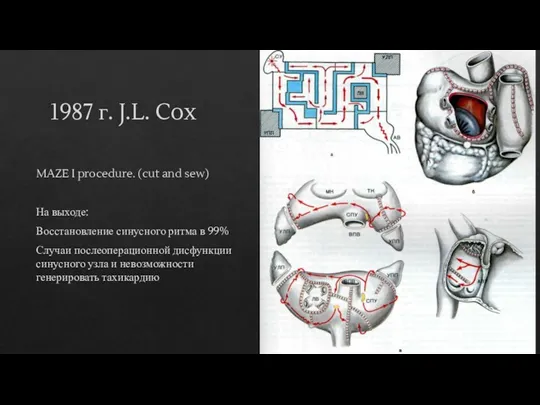 1987 г. J.L. Cox MAZE I procedure. (cut and sew)