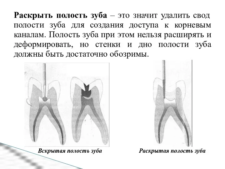 Раскрыть полость зуба – это значит удалить свод полости зуба