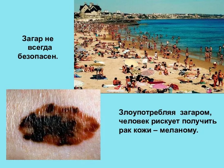 Злоупотребляя загаром, человек рискует получить рак кожи – меланому. Загар не всегда безопасен.