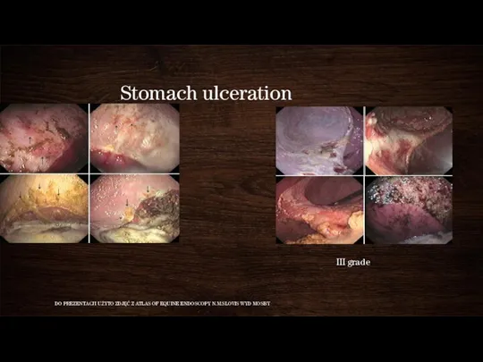 Stomach ulceration I grade DO PREZENTACJI UŻYTO ZDJĘĆ Z ATLAS